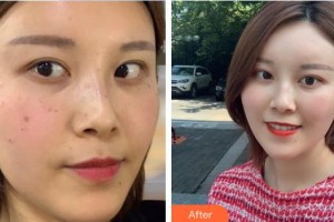 中國醫(yī)學(xué)科學(xué)院整形外科醫(yī)院穆蘭花整形價(jià)格表附激光祛斑案例展示