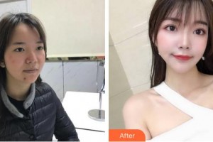 中國醫(yī)學(xué)科學(xué)院整形外科醫(yī)院劉珍君整形價(jià)格表附光子嫩膚案例展示