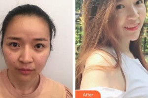 中國醫(yī)學(xué)科學(xué)院整形外科醫(yī)院趙延勇整形價(jià)格表附去痘印痘坑案例展示