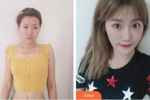 中國醫(yī)學(xué)科學(xué)院整形外科醫(yī)院宋維銘整形價(jià)格表附激光祛疤案例展示