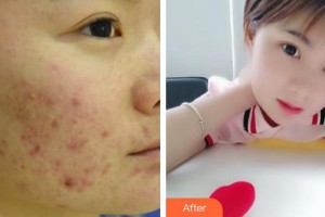 中國醫(yī)學(xué)科學(xué)院整形外科醫(yī)院周傳德整形價格表附清潔祛痘案例展示