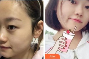 中國醫(yī)學(xué)科學(xué)院整形外科醫(yī)院金驥整形價格表附微針?biāo)獍咐故?>
</a>
<h3 class=