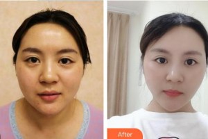 中國醫(yī)學(xué)科學(xué)院整形外科醫(yī)院潘博整形價格表附清潔祛痘案例展示