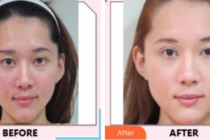 中國醫(yī)學(xué)科學(xué)院整形外科醫(yī)院牛峰整形價格表附根管調(diào)節(jié)案例展示