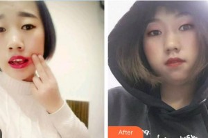 中國航天科工集團(tuán)731醫(yī)院整形美容科陳志剛整形價格表附根管調(diào)節(jié)案例展示