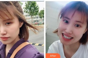 中國醫(yī)科大學(xué)航空總醫(yī)院皮膚激光整形美容中心于紅敏整形價格表附金屬托槽矯正案例展示