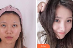 中國科大眼科醫(yī)院劉才遠(yuǎn)整形價格表附切開雙眼皮案例展示