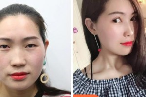 中國醫(yī)科大學(xué)附屬第一醫(yī)院整形外科孫強(qiáng)整形價格表附眼部綜合案例展示