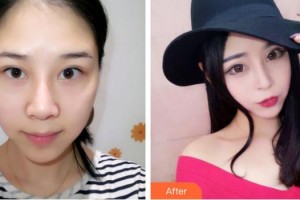 中國醫(yī)科大學(xué)附屬第一醫(yī)院整形外科郭家妍整形價格表附眼部綜合案例展示