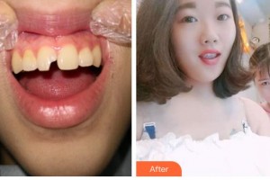 象山華美整形美容醫(yī)院馮智勇整形價(jià)格表附美白貼片案例展示