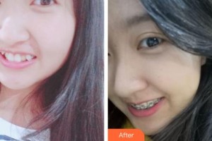 象山華美整形美容醫(yī)院洪燕整形價(jià)格表附金屬托槽矯正案例展示