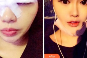 象山愛爾眼科醫(yī)院趙景峰整形價(jià)格表附切開雙眼皮案例展示