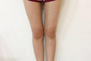 昆明醫(yī)學院整形美容中心如何？附吸脂瘦腿附果圖及價格一覽