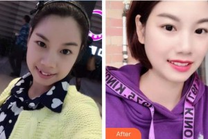 象山華美整形美容醫(yī)院郝慶忠整形價(jià)格表附金屬托槽矯正案例展示