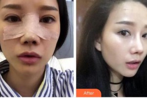 郴州市第四人民醫(yī)院王暉整形價(jià)格表附鼻部綜合案例展示