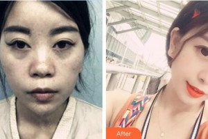 郴州市第一人民醫(yī)院整形美容科唐紅偉整形價(jià)格表附鼻部綜合案例展示