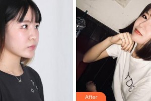 郴州市第一人民醫(yī)院整形美容科程勇整形價(jià)格表附墊鼻基底案例展示