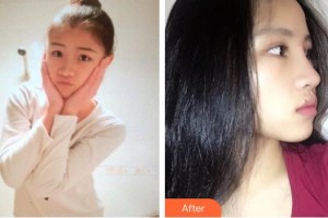 郴州市明華醫(yī)院醫(yī)學(xué)美容科竇學(xué)禮 整形價(jià)格表附鼻部綜合案例展示