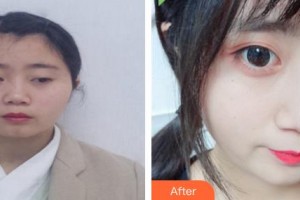 郴州市第一人民醫(yī)院整形美容科張安利整形價(jià)格表附鼻部綜合案例展示