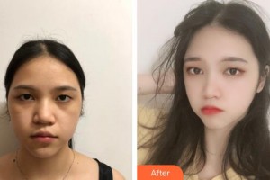 郴州曹家易麗醫(yī)療美容門診部李曉東整形價(jià)格表附去痘印痘坑案例展示