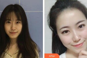 郴州唯美醫(yī)療整形醫(yī)院許艷芳整形價(jià)格表附無針?biāo)獍咐故?>
</a>
<h3 class=