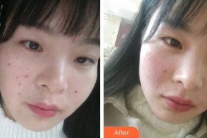 郴州瑞瀾醫(yī)療美容醫(yī)院余涵整形價(jià)格表附清潔祛痘案例展示