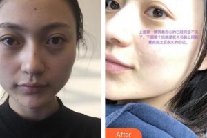 郴州瑞瀾醫(yī)療美容醫(yī)院趙小中主診醫(yī)師整形價(jià)格表附激光祛斑案例展示