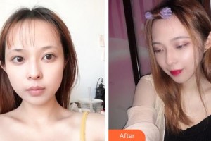 郴州愛(ài)思特醫(yī)療美容醫(yī)院易立書(shū)整形價(jià)格表附彩光嫩膚案例展示