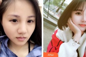 郴州市第四人民醫(yī)院王飛整形價(jià)格表附鼻部綜合案例展示