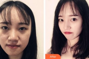 郴州市第一人民醫(yī)院整形美容科李石峰整形價(jià)格表附肋軟骨隆鼻案例展示