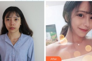 郴州市第四人民醫(yī)院沈斌整形價(jià)格表附鼻修復(fù)例展示