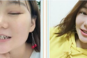 郴州冠華口腔醫(yī)院周飛整形價(jià)格表附牙齒隱形矯正案例展示