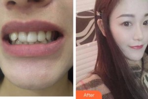 郴州市第四人民醫(yī)院鄧芳祝整形價(jià)格表附牙齒隱形矯正案例展示