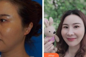 南方醫(yī)院整形美容科高建華整形價(jià)格表附射頻緊膚案例展示