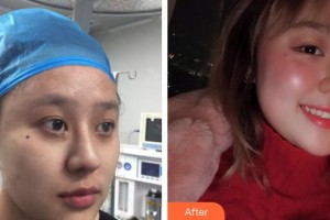 南方醫(yī)院整形美容科馮傳波整形價格表附埋線提升案例展示