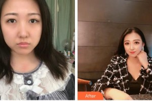 南方醫(yī)院整形美容科張立憲整形價格表附埋線提升案例展示