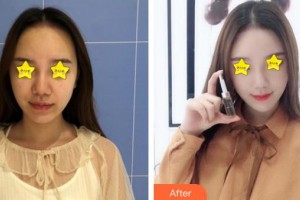 南方醫(yī)院整形美容科溫公佳住院醫(yī)師整形價格表附埋線提升案例展示