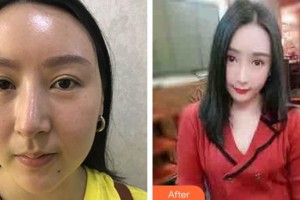 南方醫(yī)院整形美容科黎小間整形價格表附埋線提升案例展示