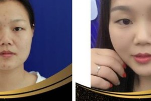 南方醫(yī)院整形美容科陳其慶住院醫(yī)師整形價(jià)格表附埋線提升案例展示