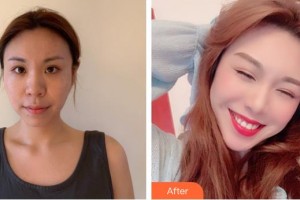 南方醫(yī)院整形美容科楊澄宇住院醫(yī)師整形價(jià)格表附埋線提升案例展示