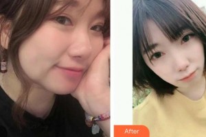 南方醫(yī)院整形美容科胡志奇整形價格表附熱拉提案例展示