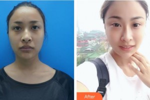 白求恩國際和平醫(yī)院整形美容中心張軼整形價格表附埋線提升案例展示