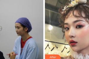 白求恩國際和平醫(yī)院整形美容中心安亮恩整形價格表附埋線提升案例展示