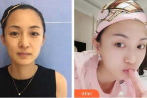 白求恩國際和平醫(yī)院整形美容中心趙曉程整形價格表附埋線提升案例展示