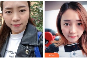 樂清華山中西醫(yī)結(jié)合醫(yī)院醫(yī)學整形美容中心蔣伯熙整形價格表附黃金微針案例展示