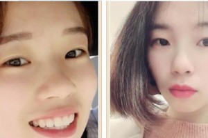 樂清牙科醫(yī)院徐鵬整形價格表附牙齒陶瓷矯正案例展示