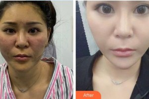 暨南大學附屬第一醫(yī)院整形美容激光中心李康英  整形價格表附牙齒陶瓷矯正案例展示