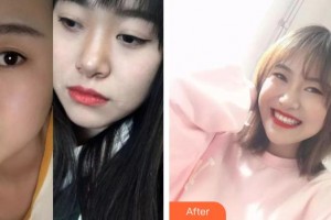 暨南大學附屬第一醫(yī)院整形美容激光中心肖麗玲整形價格表附金屬托槽矯正案例展示