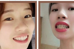 暨南大學附屬第一醫(yī)院整形美容激光中心謝波 整形價格表附牙齒隱形矯正案例展示