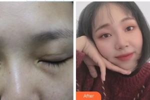 永康常春藤醫(yī)療美容診所陳珺怡整形價格表附眼部修復案例展示